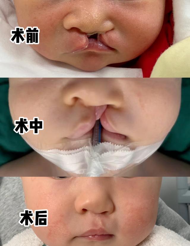 乐鱼体育官网网页版-对话口腔颌面外科专家陈亦阳：唇腭裂没那么可怕，规范治疗后可与常人无异 | 嫣然医院欠租风波背后